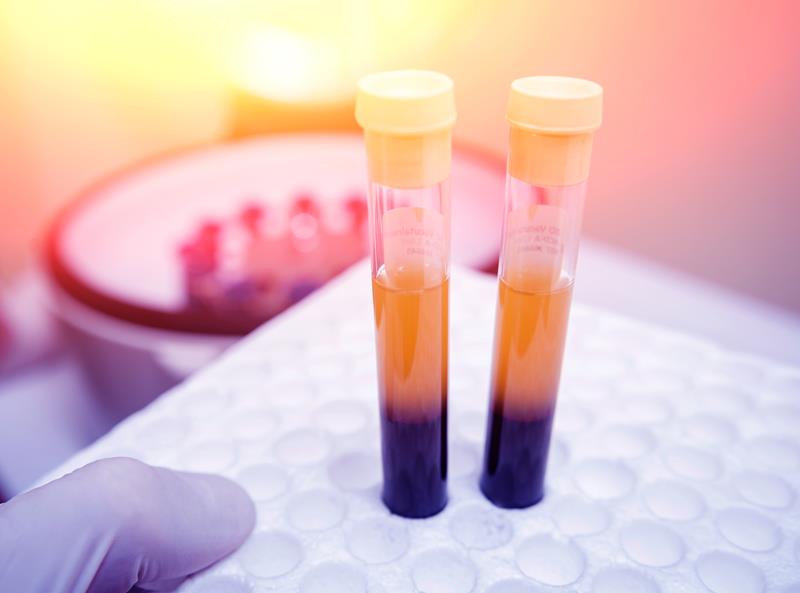 Platelet Rich Plasma Preparation